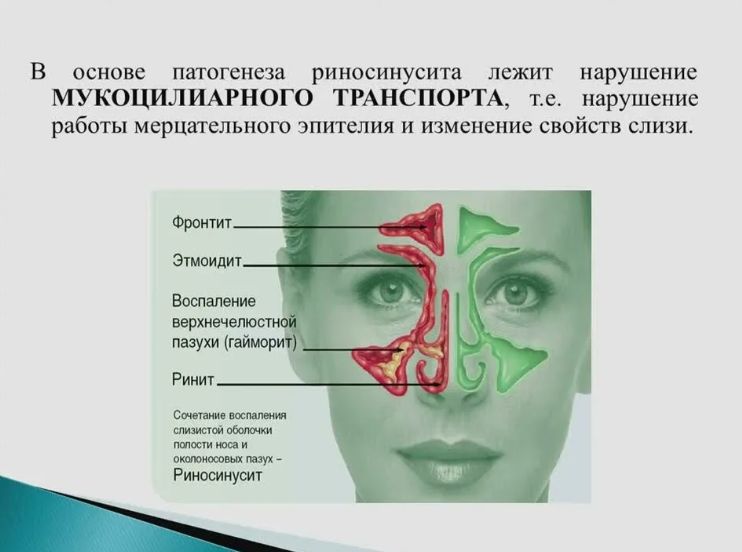 Как вылечить насморк в домашних условиях